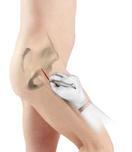 Minimally Invasive Anterior Hip Replacement