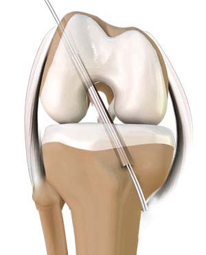 ACL Reconstruction Procedure - Quadriceps Tendon