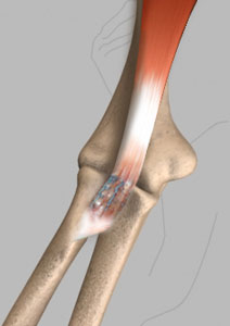 Biceps Tendon Tear at the Elbow