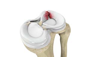 Meniscus Tears Treatment Cuyahoga Falls, OH