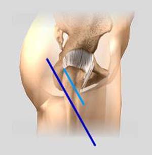 Minimally Invasive Posterior Hip Replacement
