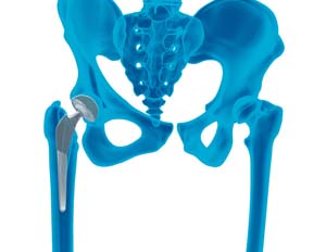 Outpatatient Hip Replacement