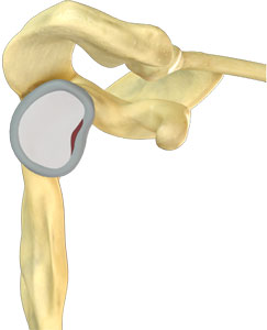 Shoulder Labrum Tear