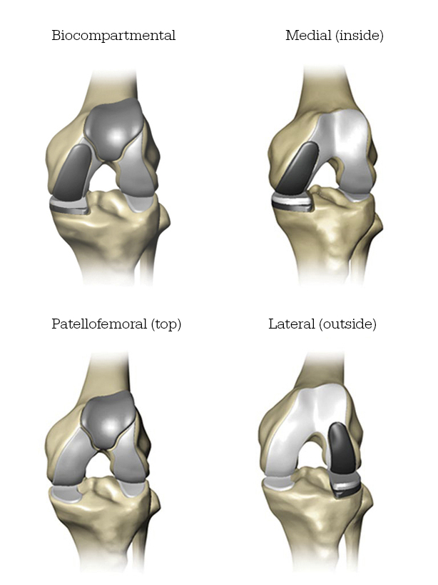 Mako Robotic-Arm Assisted Technology forPartialKneeReplacement