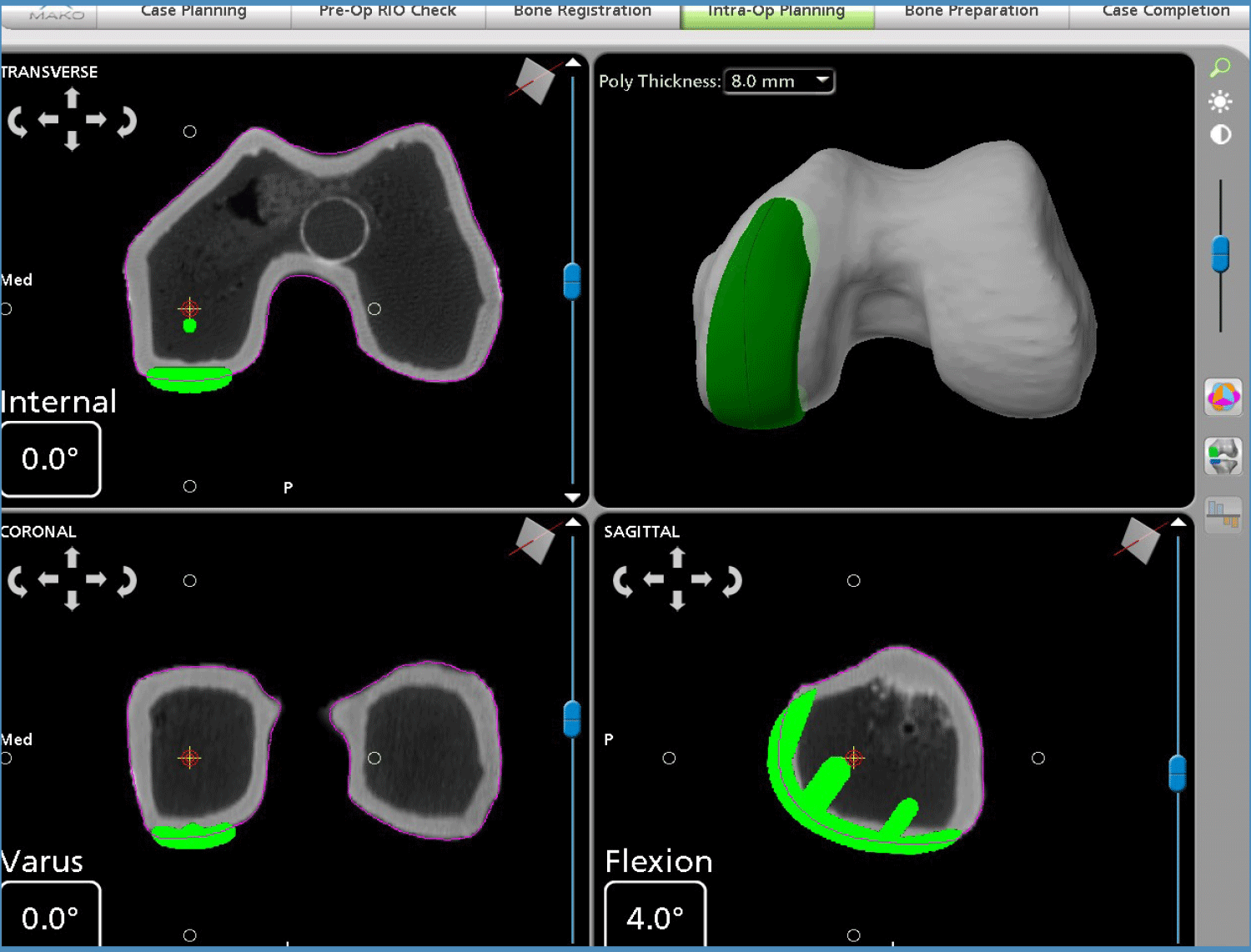 Mako Robotic-Arm Assisted Technology forPartialKneeReplacement