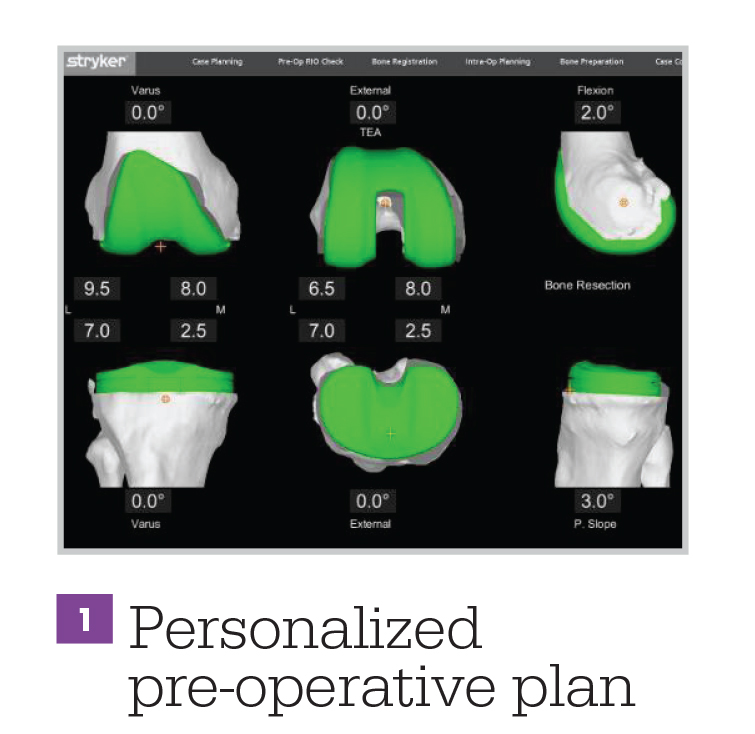 Mako Robotic-Arm Assisted Technology for Total Knee Replacement