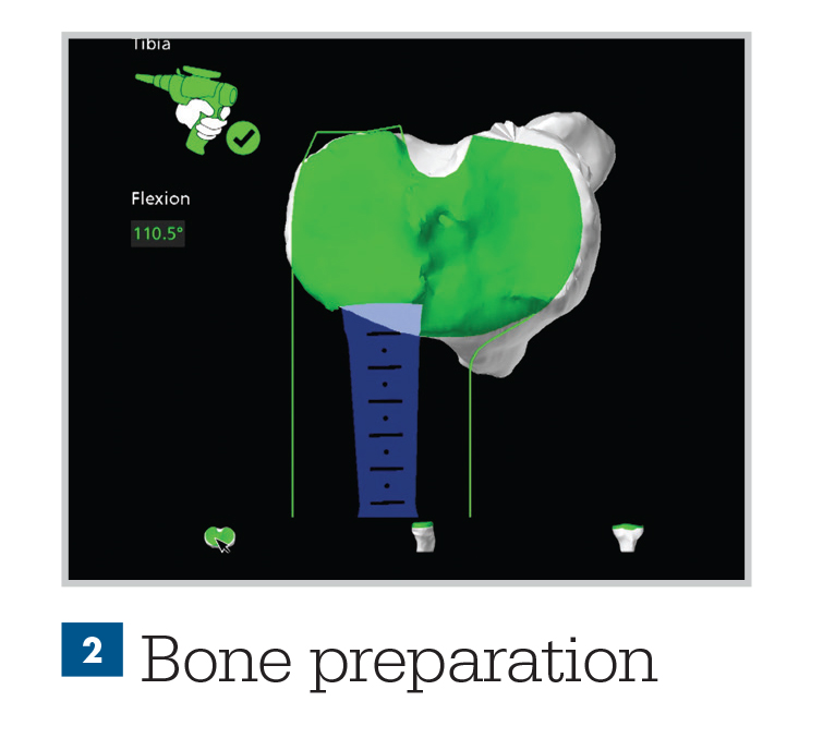 Mako Robotic-Arm Assisted Technology for Total Knee Replacement